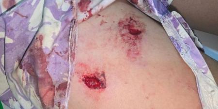 كلاب ضالة تهاجم طفلا وترسله إلى قسم الإنعاش بأكادير